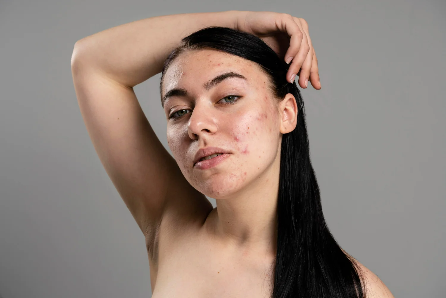 Foto de uma mulher com cicatriz de acne.